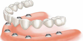 Ilustration of an all-on-eight denture.