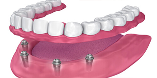 Ilustration of an all-on-four denture.