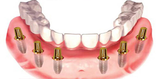 Ilustration of an all-on-six denture.