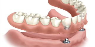 Ilustration of an all-on-two denture.