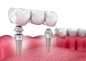 Illustration of the upper teeth showing the 	placement of a bridge between two implants.