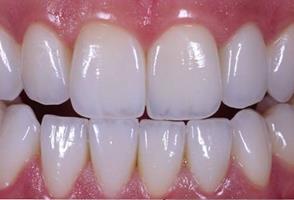 Close-up picture of upper and lower perfect teeth shown with Emax pure porcelain Zirconium crowns.