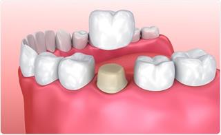 Illustration of how a metal porcelain crown fits on a rehaped tooth.