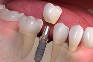 Picture of the lower jaw showing 6 teeth and the placement of a dental implant crown in the middle