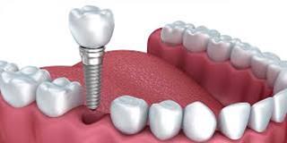 Illustration of several teeth, one of which is a dental implant.