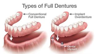 Illustration of a full set of dentures with 2 implants