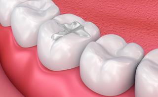 Picture showing 3 white fillings