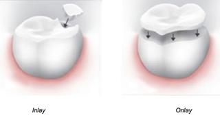 Illustration of two teeth, one showing a dental inlay and the other showing a dental onlay
