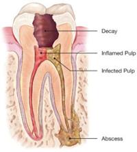 Illustration of a tooth showing the access for a root canal and how it is done