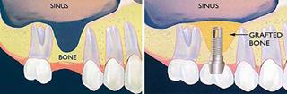 Illustration of a sinus lift showing bone grafts to the sinus area